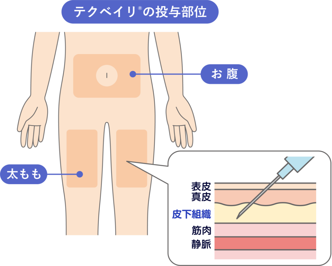 テクベイリ®の投与部位のイメージ図