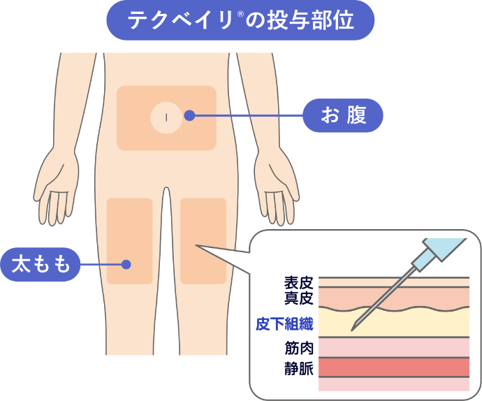 テクベイリ®の投与部位のイメージ図